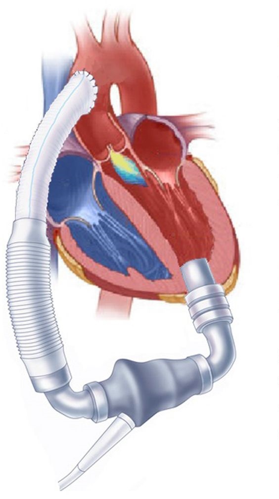 Операция система. Искусственный механический желудочек сердца. Искусственный левый желудочек сердца. Вспомогательный левый желудочек. Имплантация искусственного сердца.